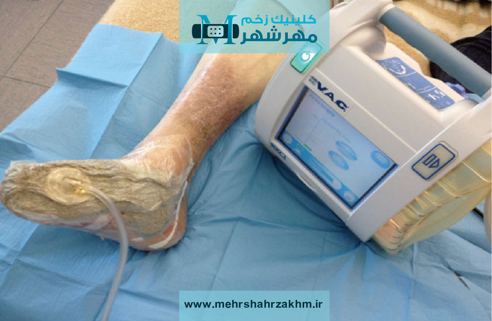 وکیوم تراپی زخم در مهرشهر|دکتر متخصص زخم در مهرشهر|هشتگرد