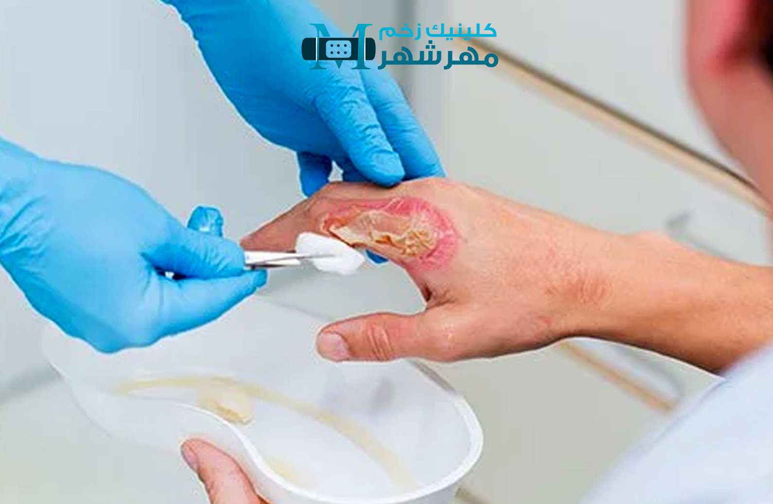 پیشگیری از ایجاد زخم سوختگی