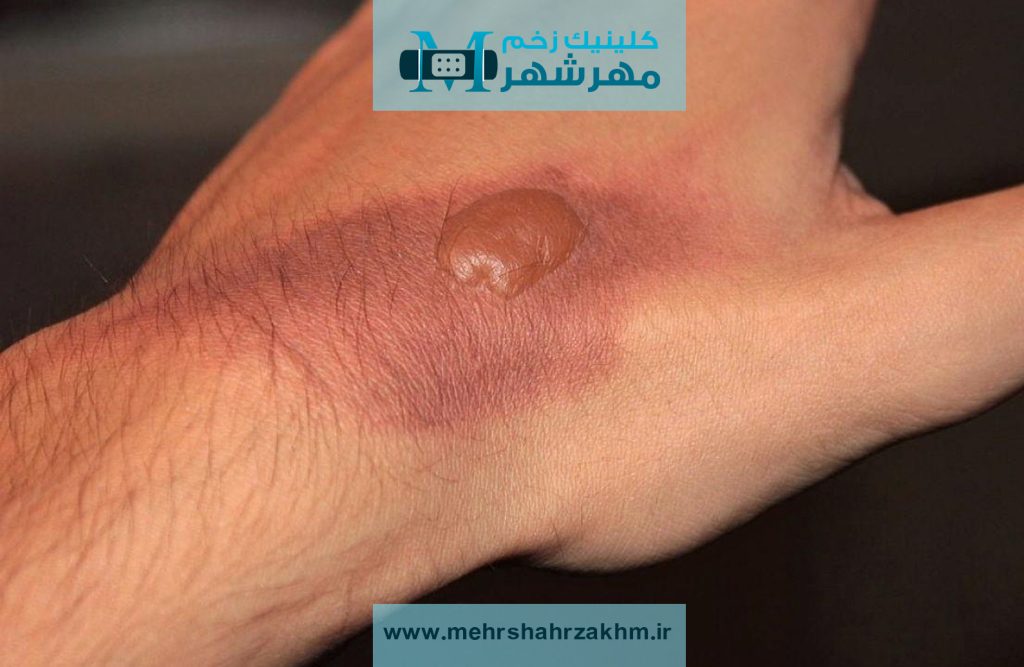 درمان سوختگی با آب جوش|متخصص درمان سوختگی در کرج