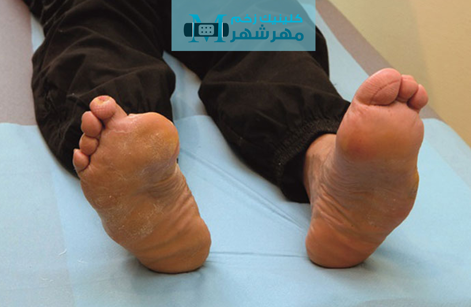 روش جراحی برای درمان زخم پای دیابتی