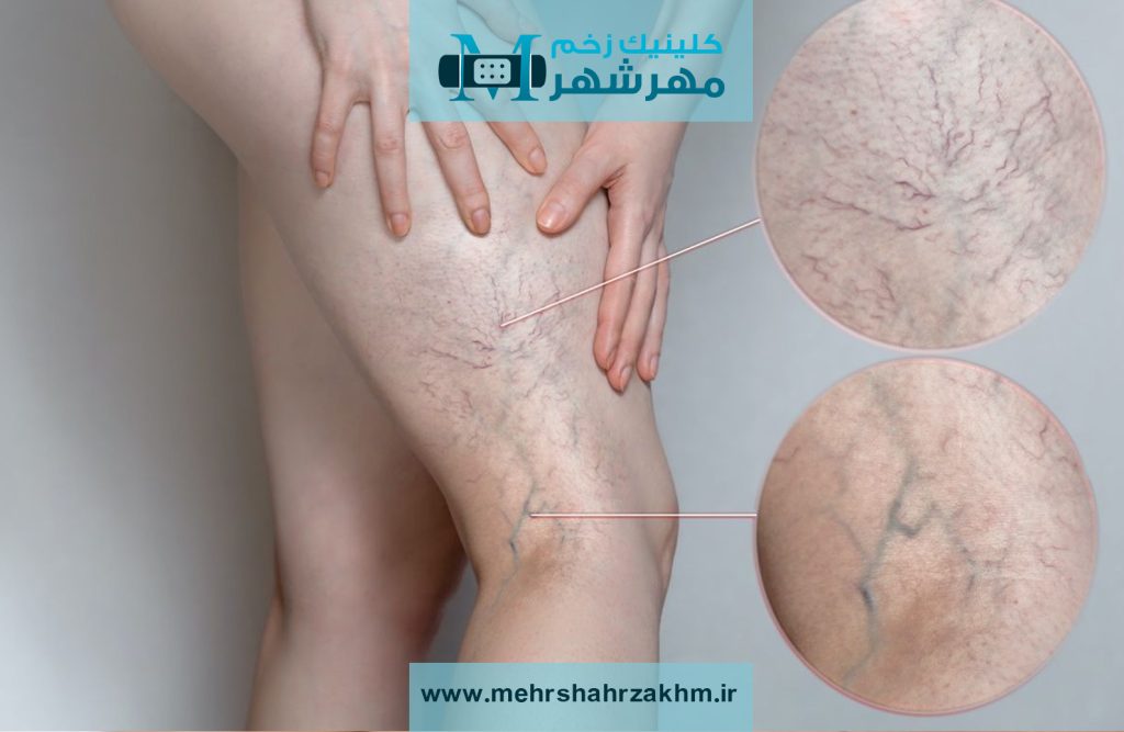 زخم واریسی یا زخم وریدی در مهرشهر|دکتر فوق تخصص زخم واریس در مهرشهر