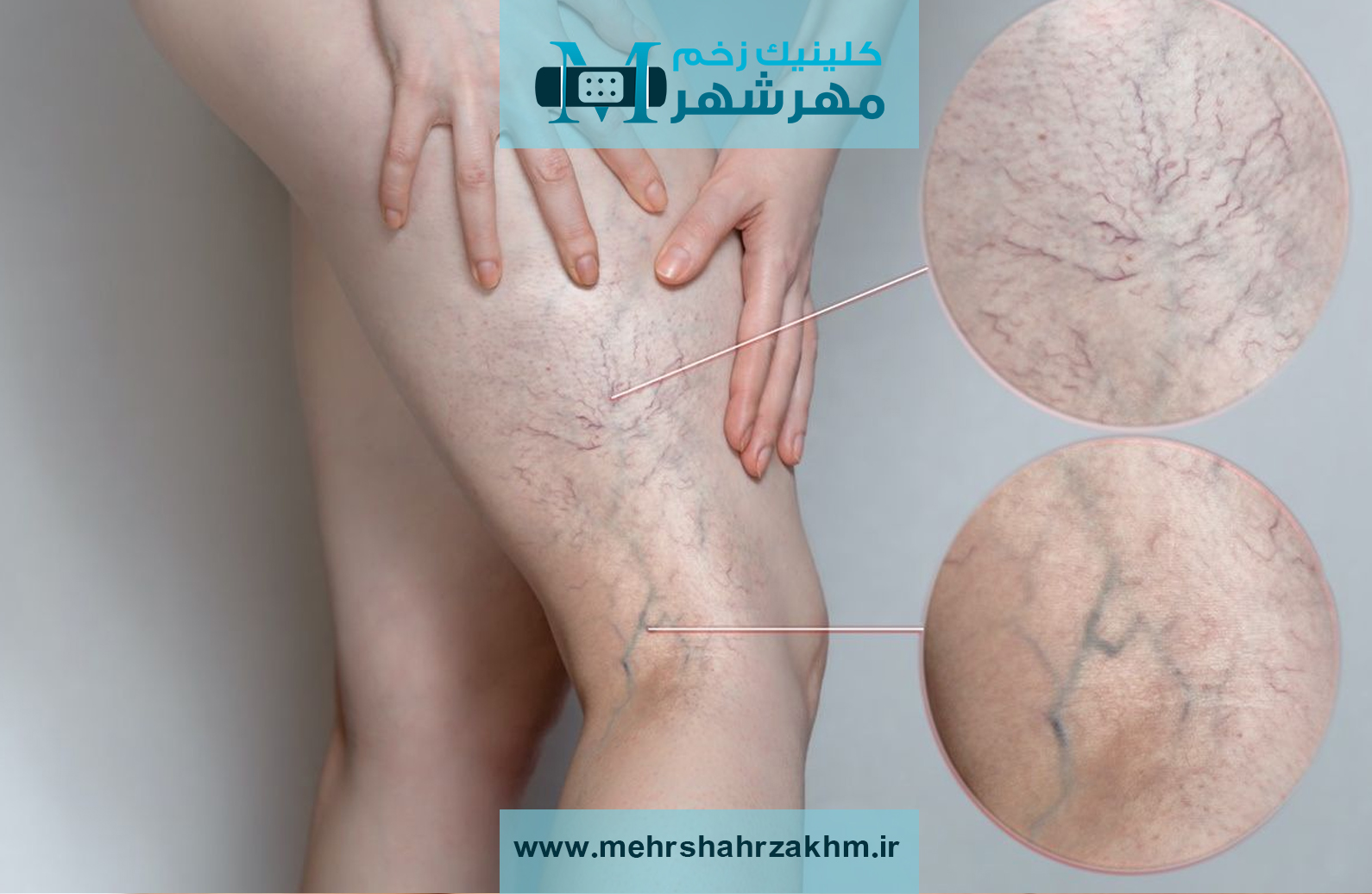 زخم واریسی یا زخم وریدی در مهرشهر|دکتر فوق تخصص زخم واریس در مهرشهر