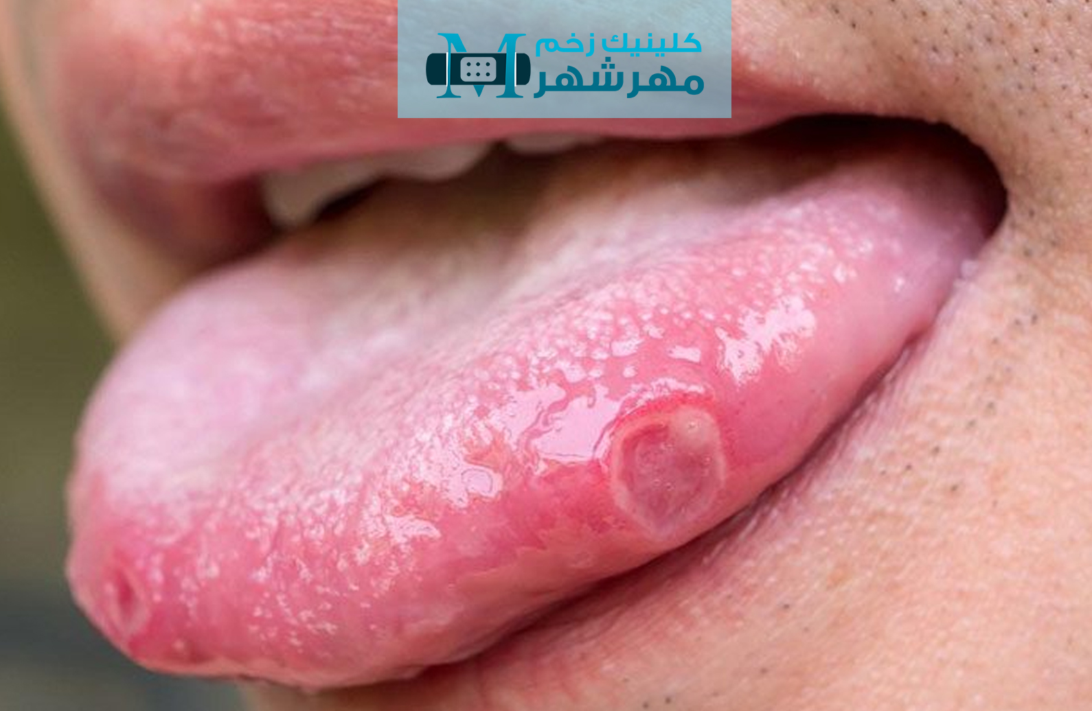 چه نتایج درمانی پس از رادیوتراپی زخم های بدخیم قابل انتظار است؟