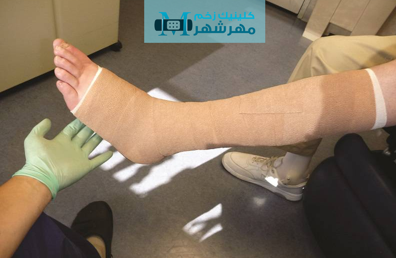 علائم ظاهری زخم واریس پا