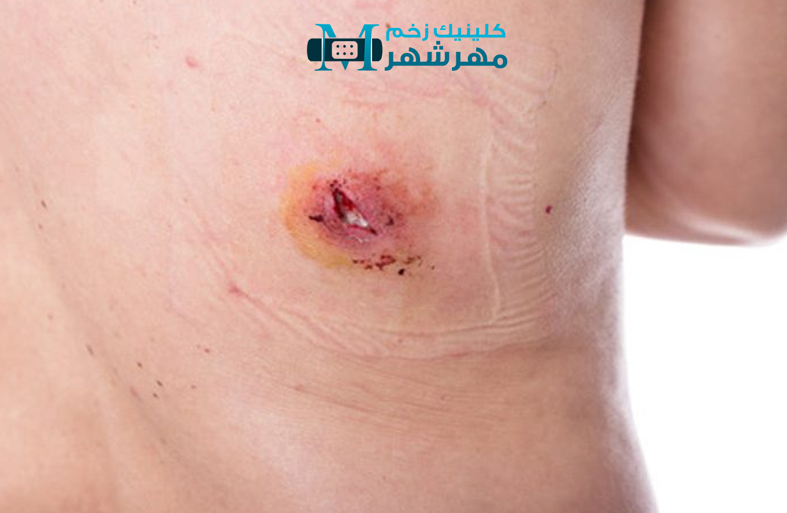پیشگیری از عفونت زخم