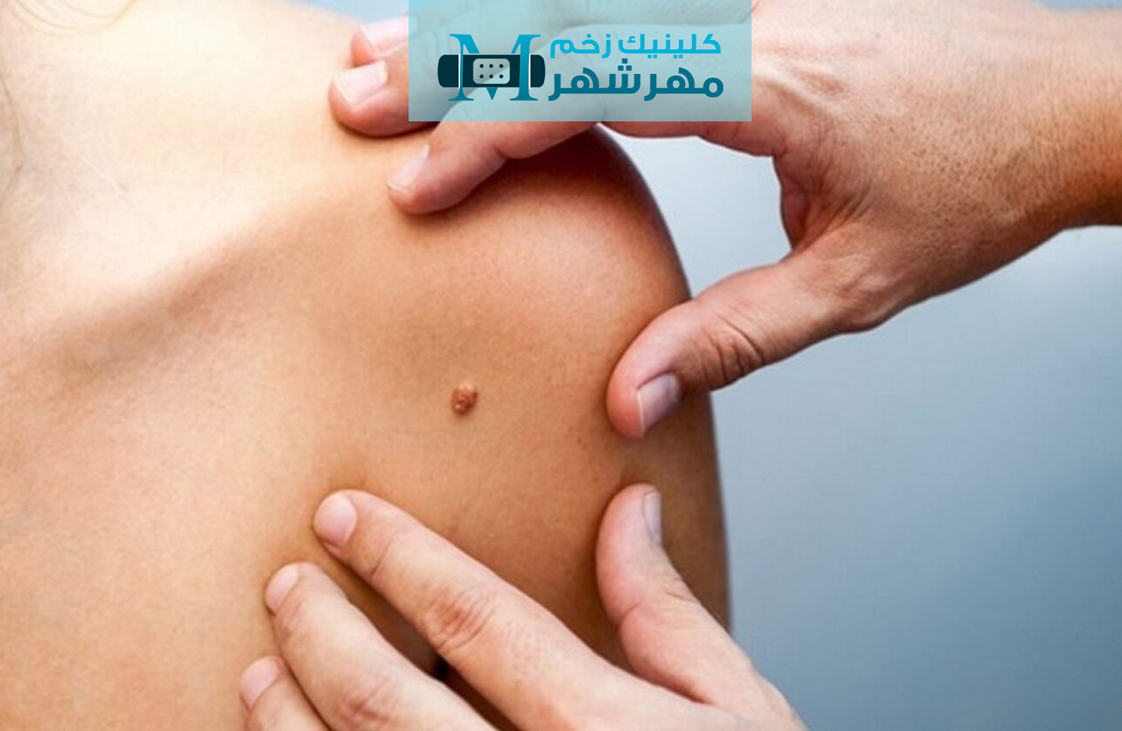 چگونگی مراقبت از زخم های سرطانی