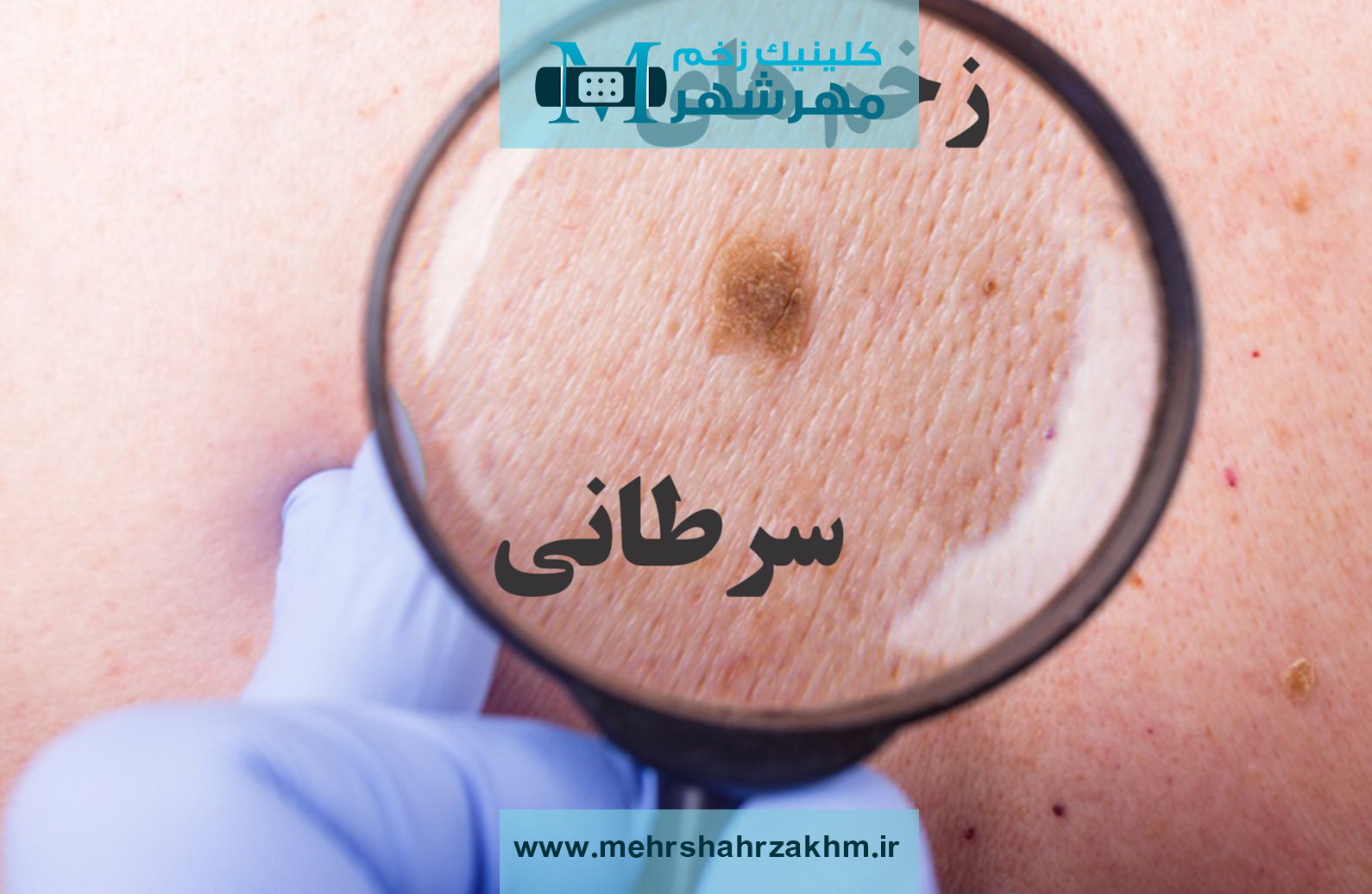 زخم‌ های سرطانی چیست|درمان زخم های سرطانی در کرج|پانسمان زخم های سرطانی در مهرشهر