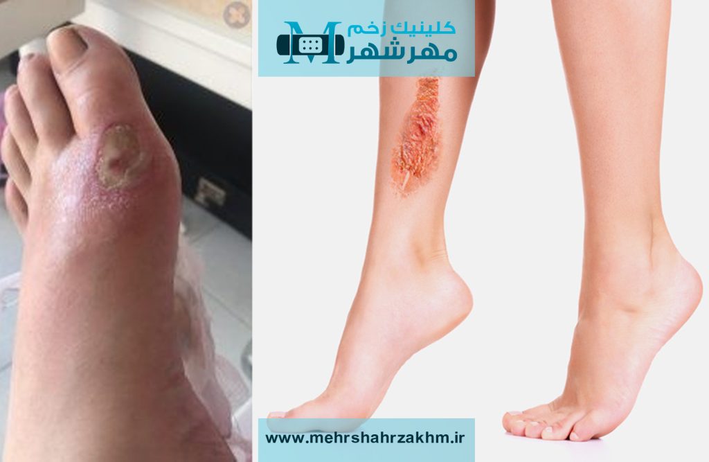 زخم‌ های شریانی |درمان زخم‌ های شریانی در کرج|کارشناس تخصصی زخم و پانسمان در منزل کرج