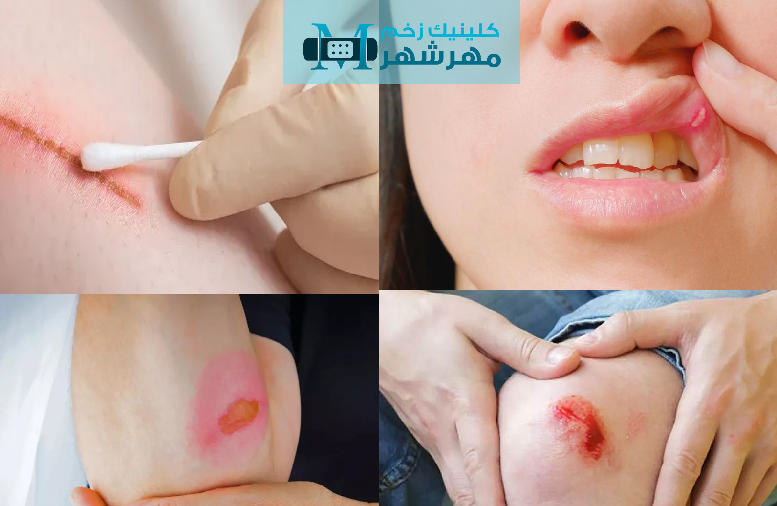 هشت(8) نوع از رایج‌ترین و مهم‌ترین زخم‌ها