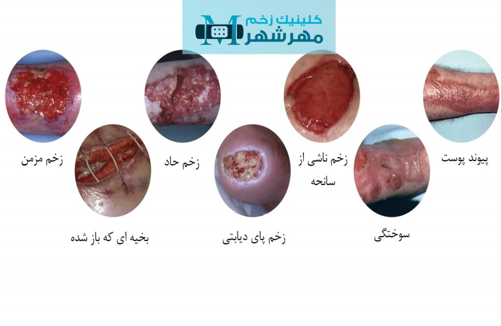 انواع زخم چیست|درمان انواع زخم در کرج|کلینیک درمان زخم | درمان زخم بستر | درمان زخم پای دیابتی