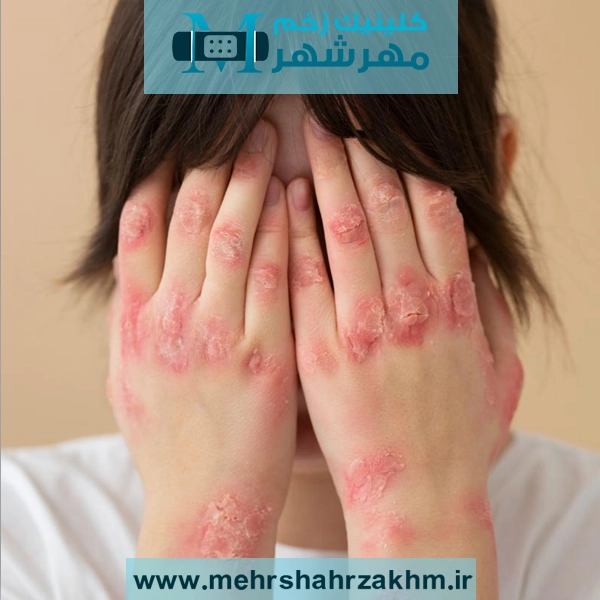 زرد زخم چیست، علائم زرد زخم و راه های درمان زرد زخم چیست؟