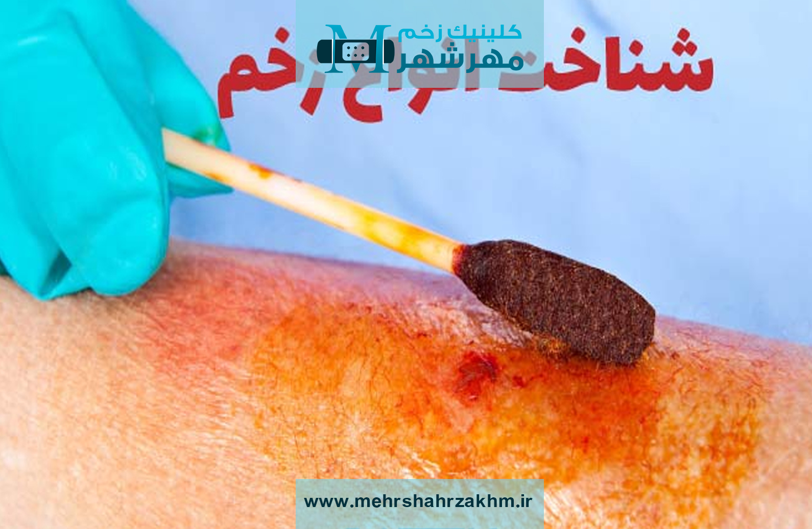 زخم‌ های عفونی چیست|درمان زخم عفونی در کرج|بهترین دکتر فوق تخصص عفونت زخم کرج|بهترین فوق تخصص عفونی در کرج