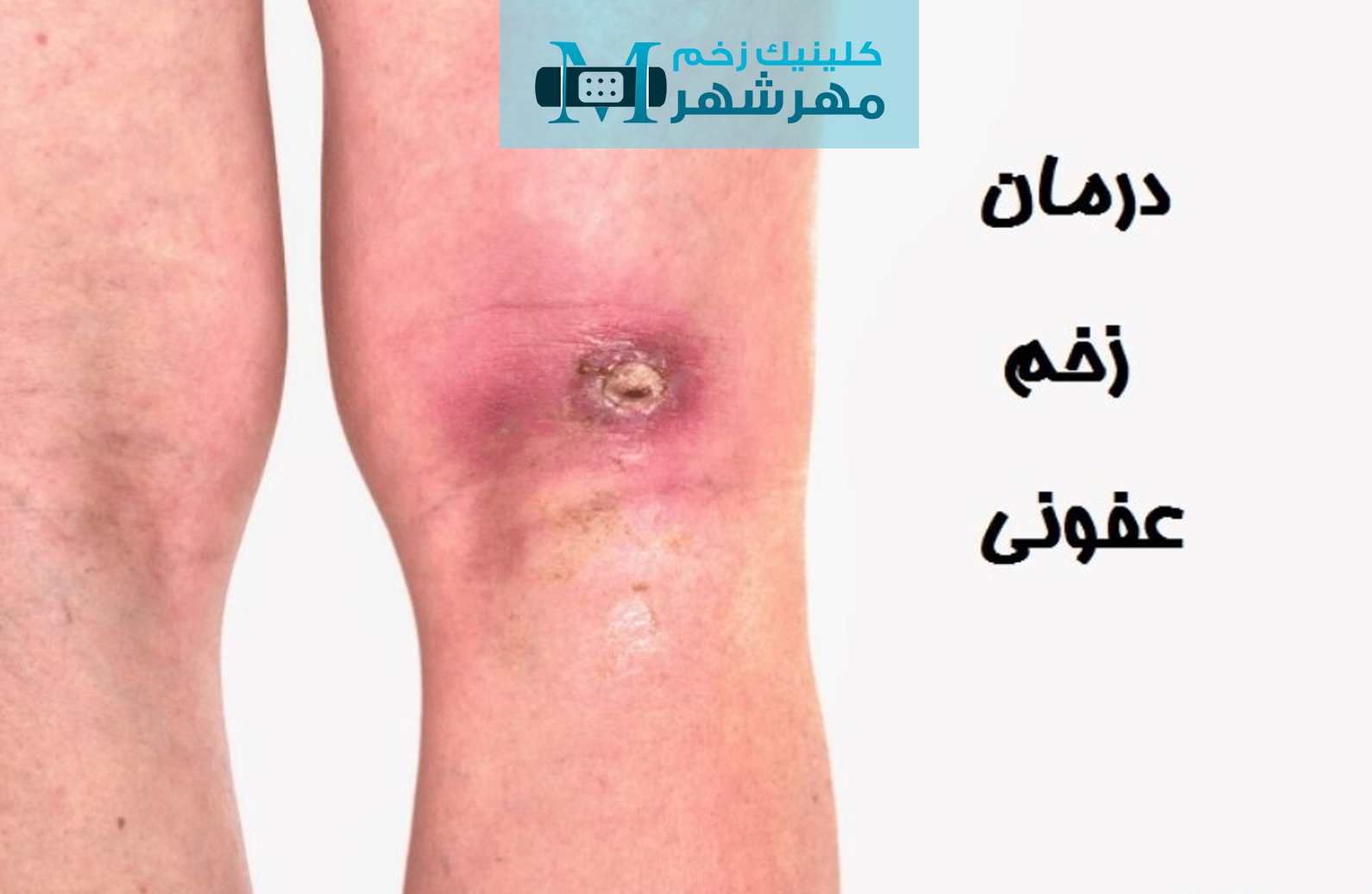 علل اصلی ایجاد زخم‌های عفونی