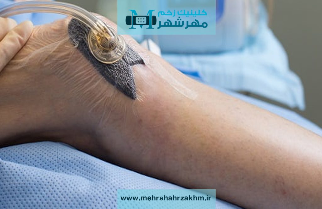 وکیوم تراپی برای بهبود زخم‌ در کرج |وکیوم تراپی چیست؟