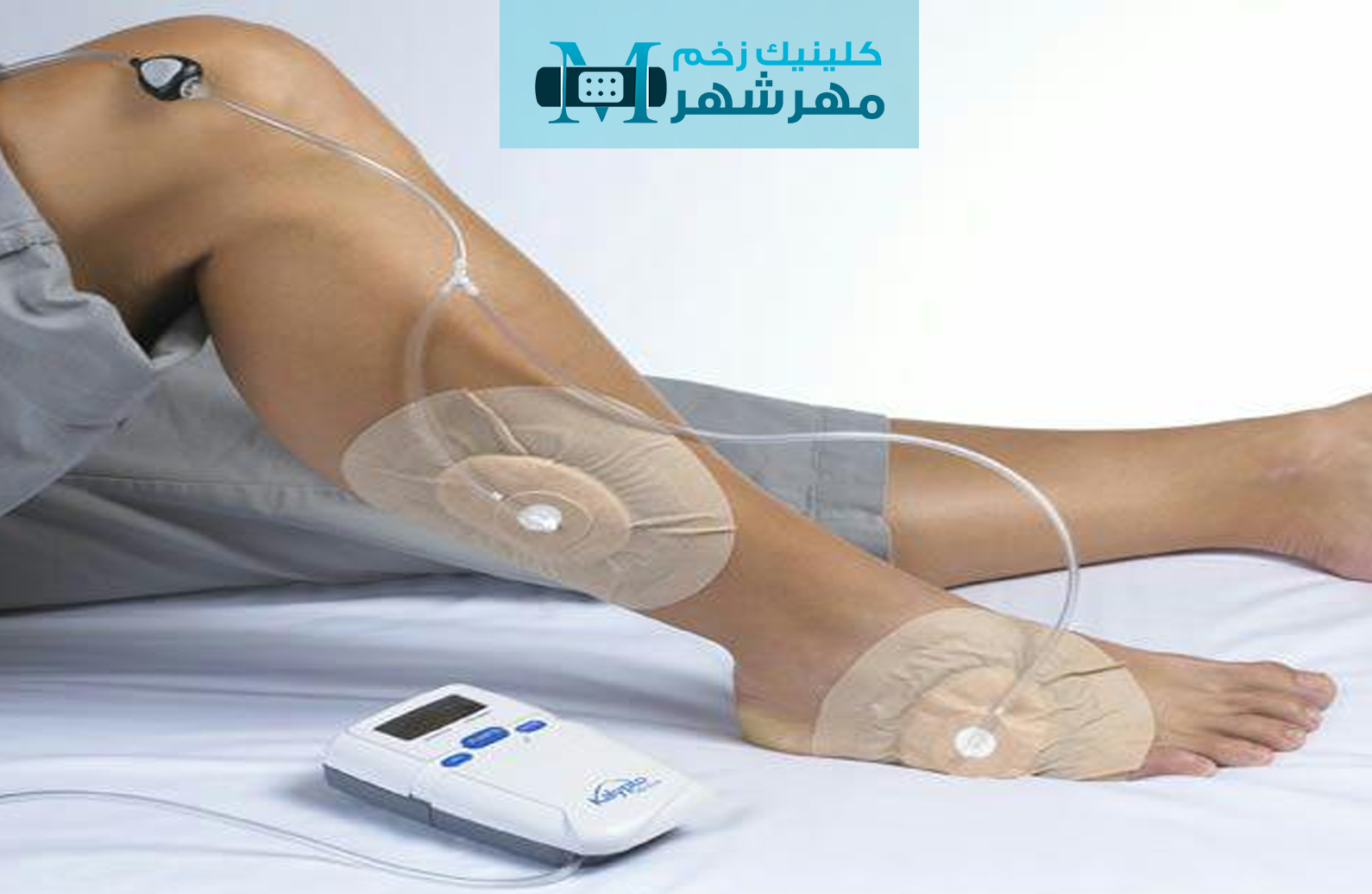 نتیجه‌ گیری وکیوم تراپی برای بهبود زخم‌ در کرج 