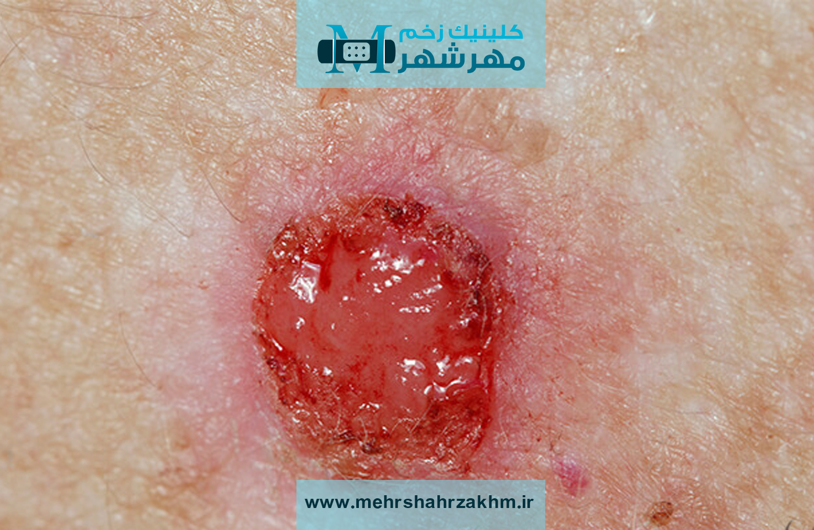 برای پیشگیری از ایجاد زخم های سرطانی چه اقداماتی لازم است؟