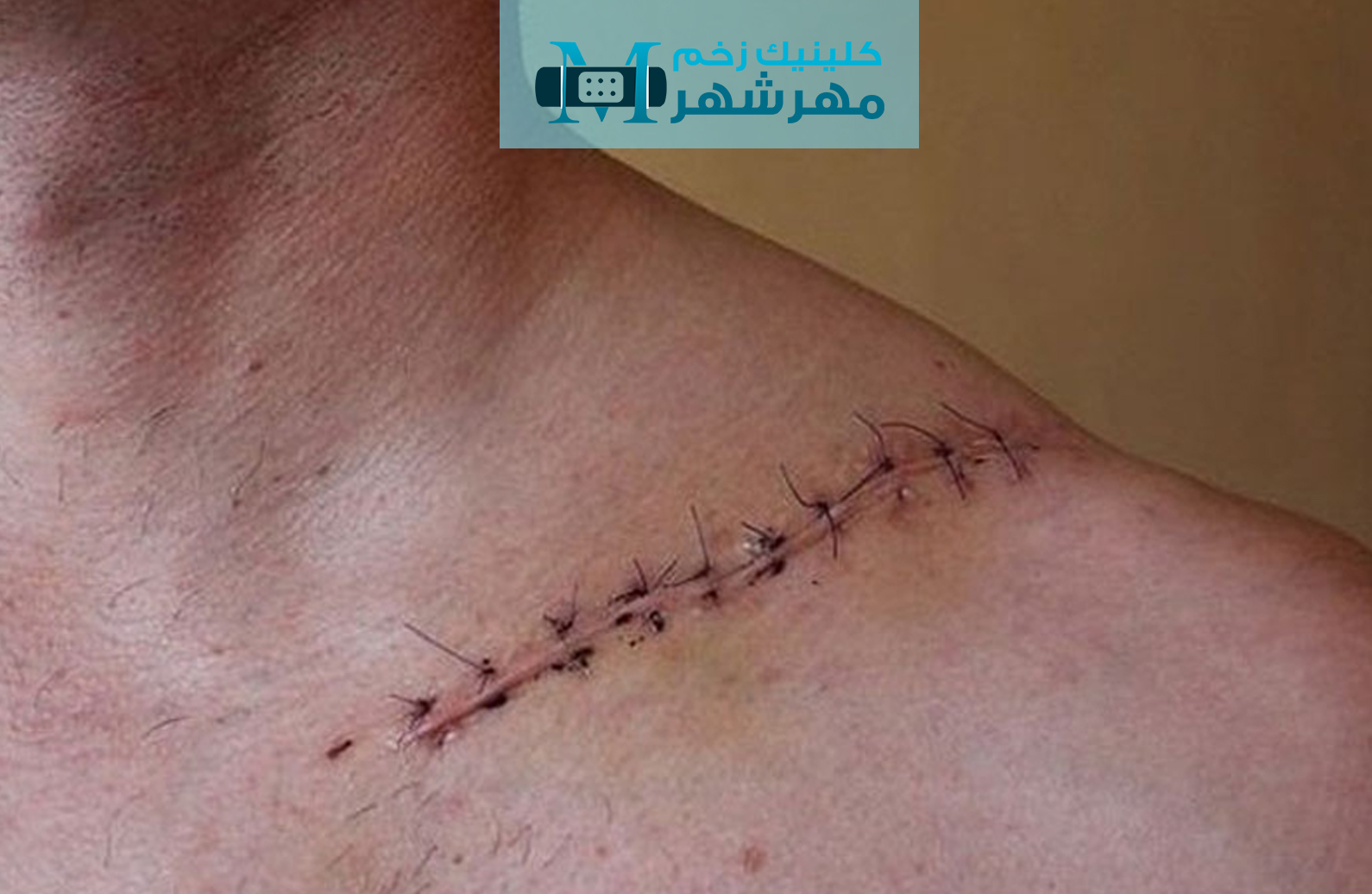 نکات مهم در مراقبت از زخم جراحی