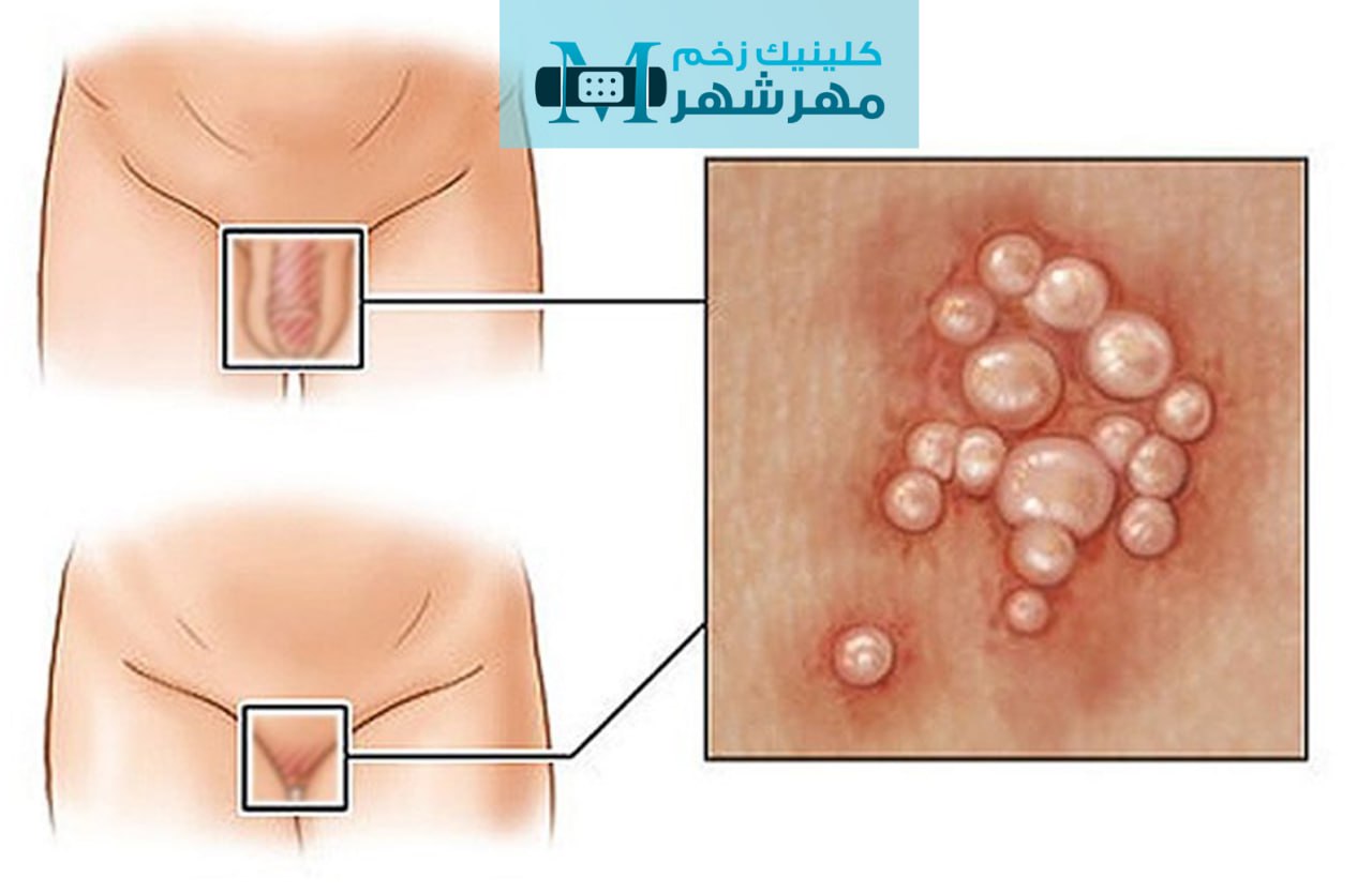 دوره کمون ویروس هرپس چقدر است؟