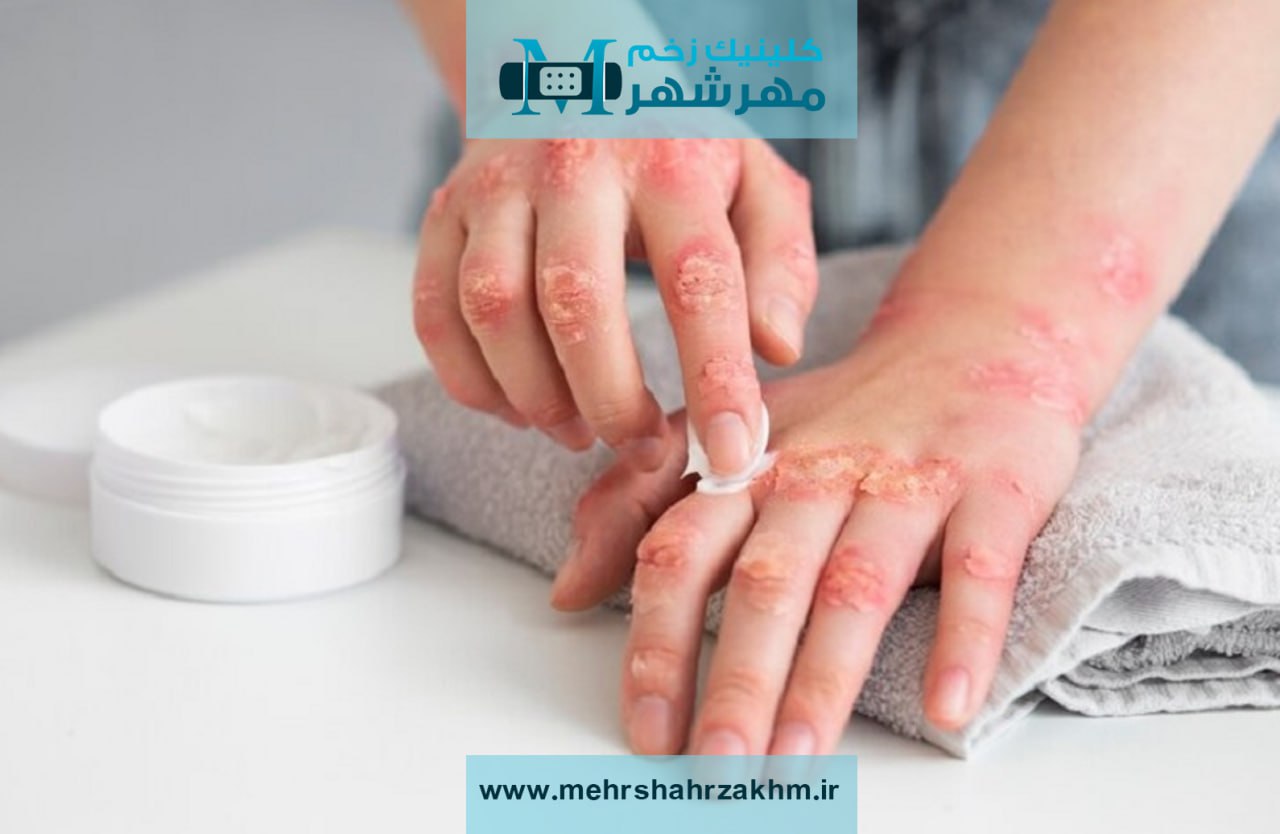 زخم‌ های ناشی از عفونت‌ های قارچی|متخصص زخم‌ های عفونت‌ قارچی در کرج|متخصص بیماریهای قارچی کرج