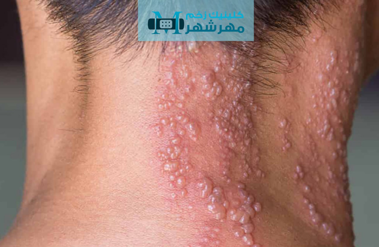 انواع عفونت‌ های قارچی