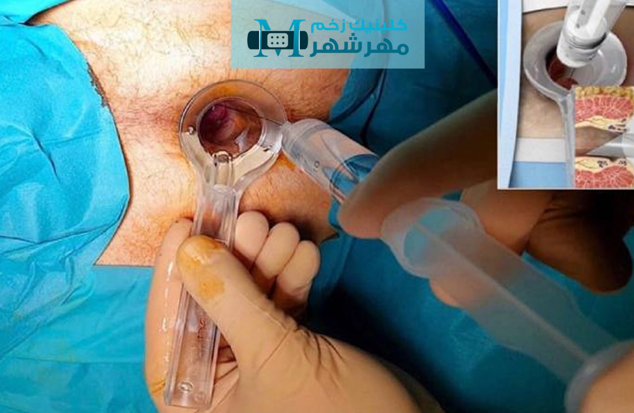 راهکارهای پزشکی برای درمان بواسیر