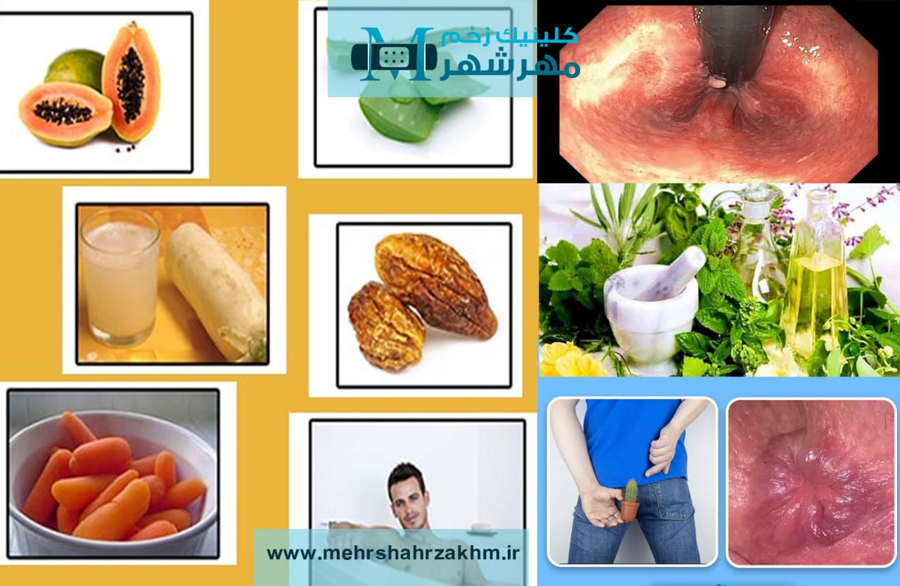 درمان زخم بواسیر در کرج|درمان زخم بواسیر در مهرشهر|بواسیر ,شقاق,هموروئید کرج