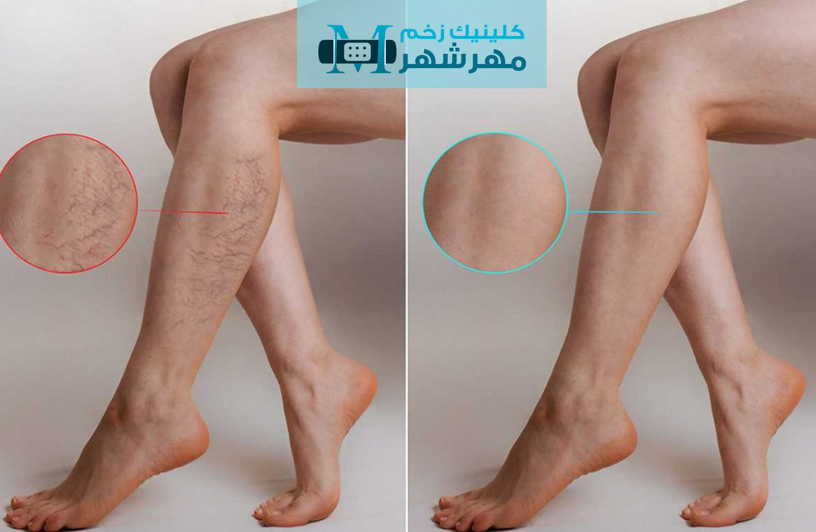 نکات مهم در استفاده از پانسمان نقره