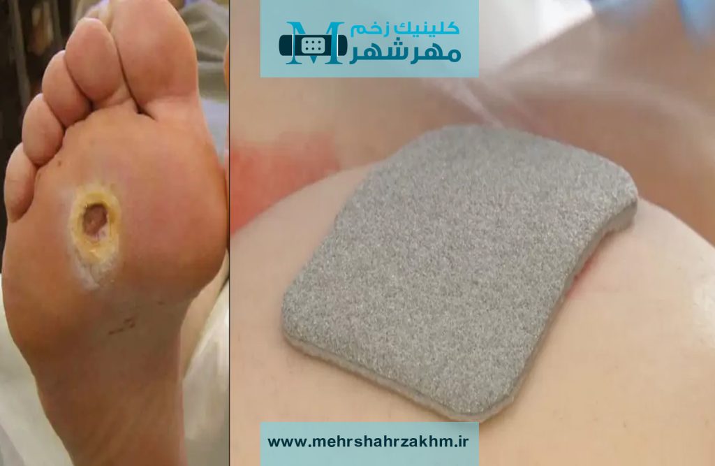 پانسمان نقره برای درمان زخم پای دیابتی در کرج|پانسمان نقره زخم دیابتی در کرج