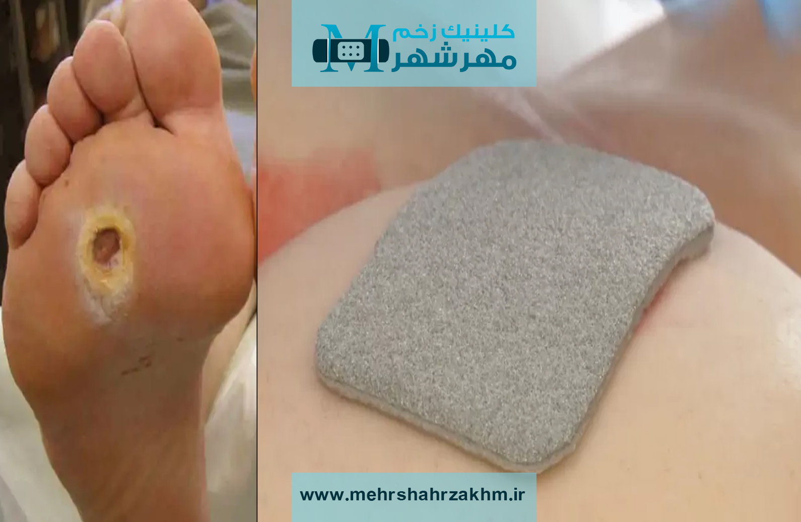 پانسمان نقره برای درمان زخم پای دیابتی در کرج|پانسمان نقره زخم دیابتی در کرج