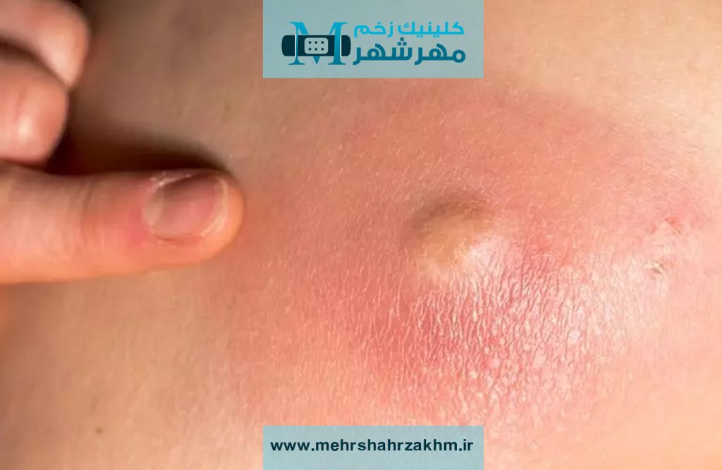 زخم‌های مزمن و مشکل های پوستی|متخصص زخم‌های مزمن و مشکل های پوستی در کرج