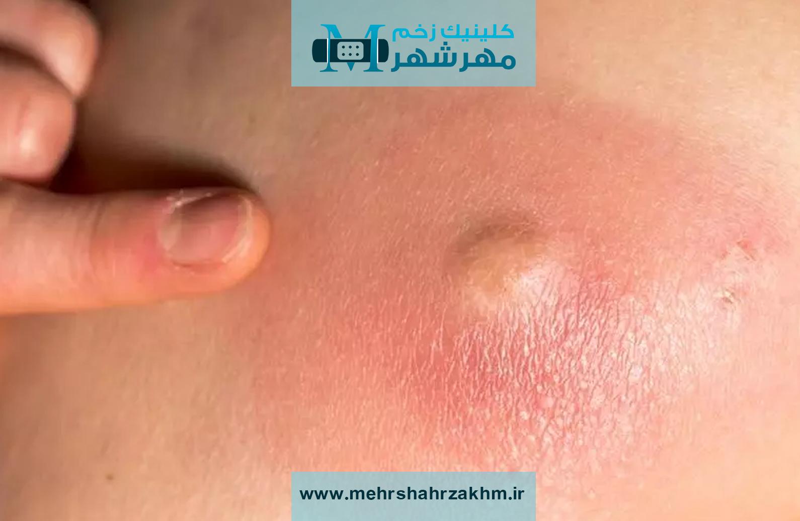 زخم‌های مزمن و مشکل های پوستی|متخصص زخم‌های مزمن و مشکل های پوستی در کرج