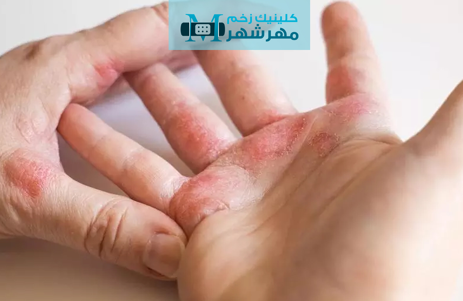 پیسی یا ویتلیگو(Vitiligo)