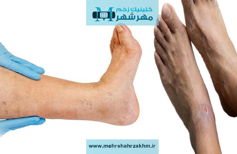 درمان زخم عروقی در کرج|روش های درمان زخم های شریانی و عروقی|کلینیک درمان زخم و دیابت در کرج