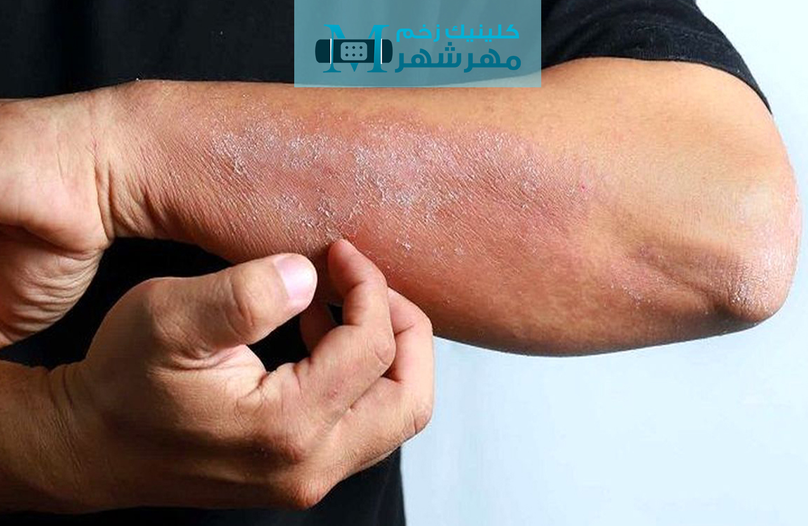 زخم های ناشی از بیماری‌های خودایمنی