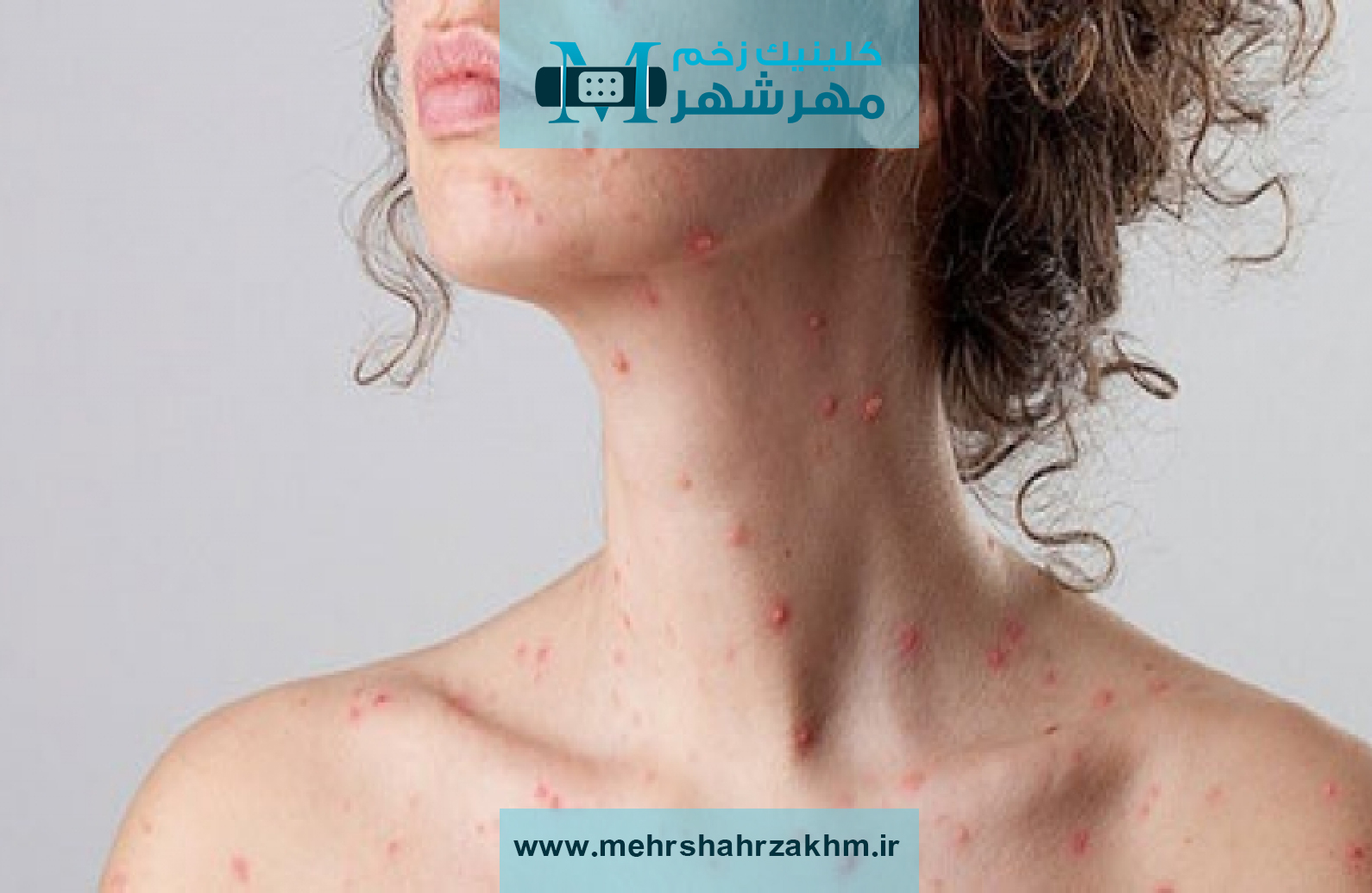 بهترین روش های درمان زونا یا هرپس زوستر در خانه و کلینیک