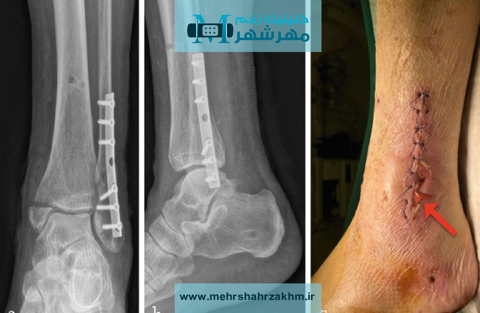 عفونت زخم جراحی چرا اتفاق می افتد و چگونه درمان می شود؟