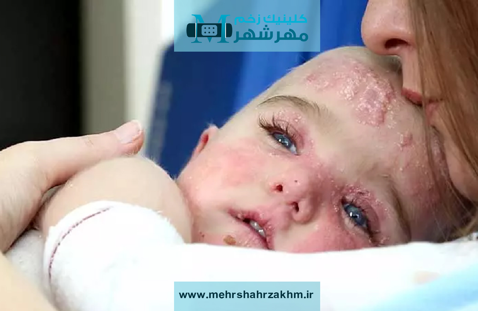 راهکارهای کاربردی کنترل بیماری پروانه ای در کودکان و بزرگسالان