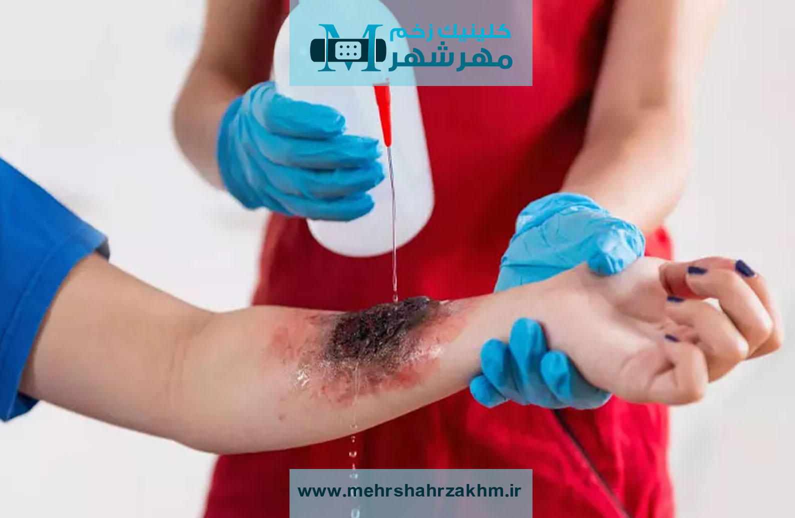 نکات مهم در انتخاب پانسمان سوختگی برای بهبودی بهتر