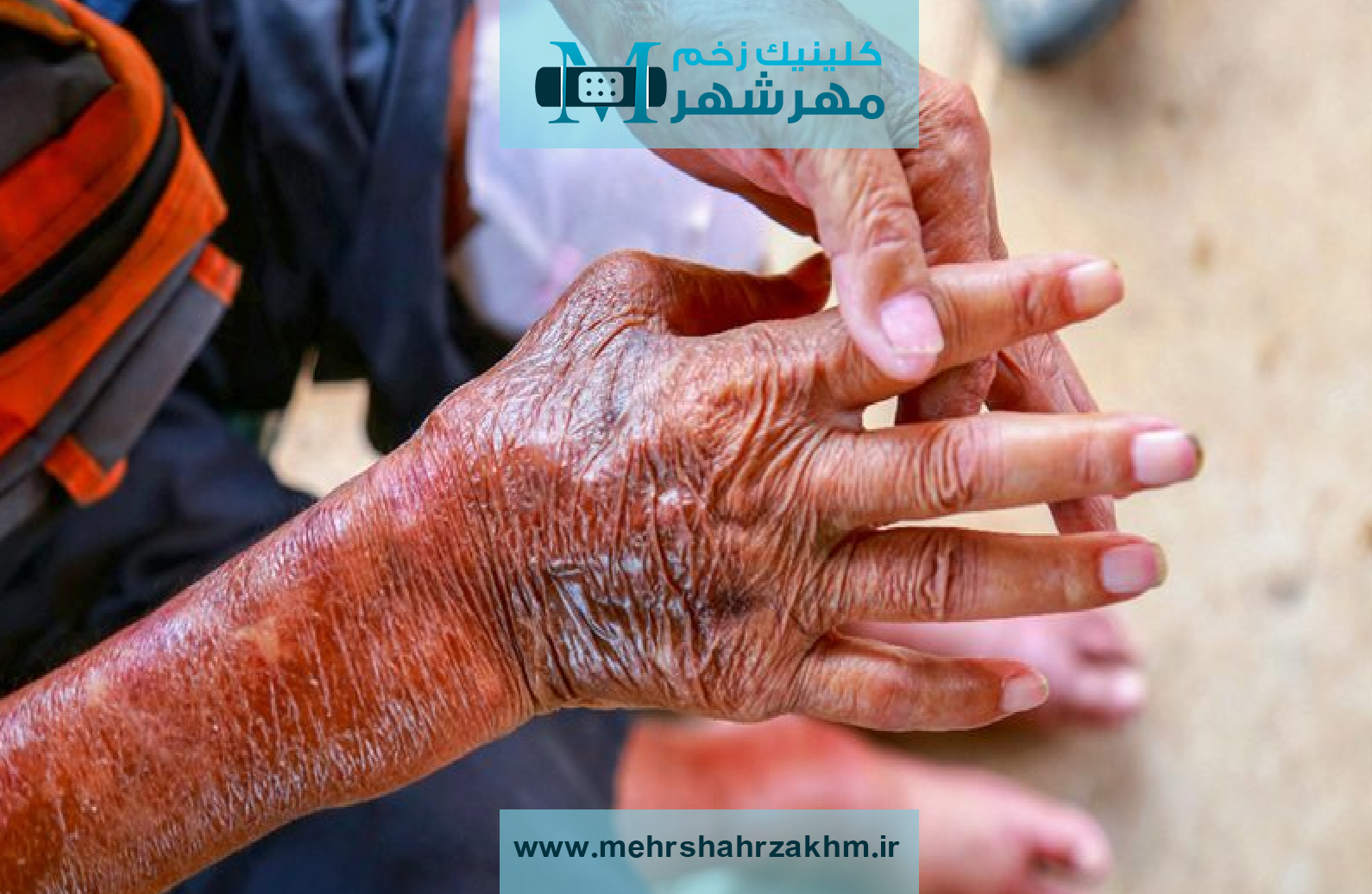 اسکلرودرمی چیست و چگونه بر بدن تأثیر می‌گذارد؟