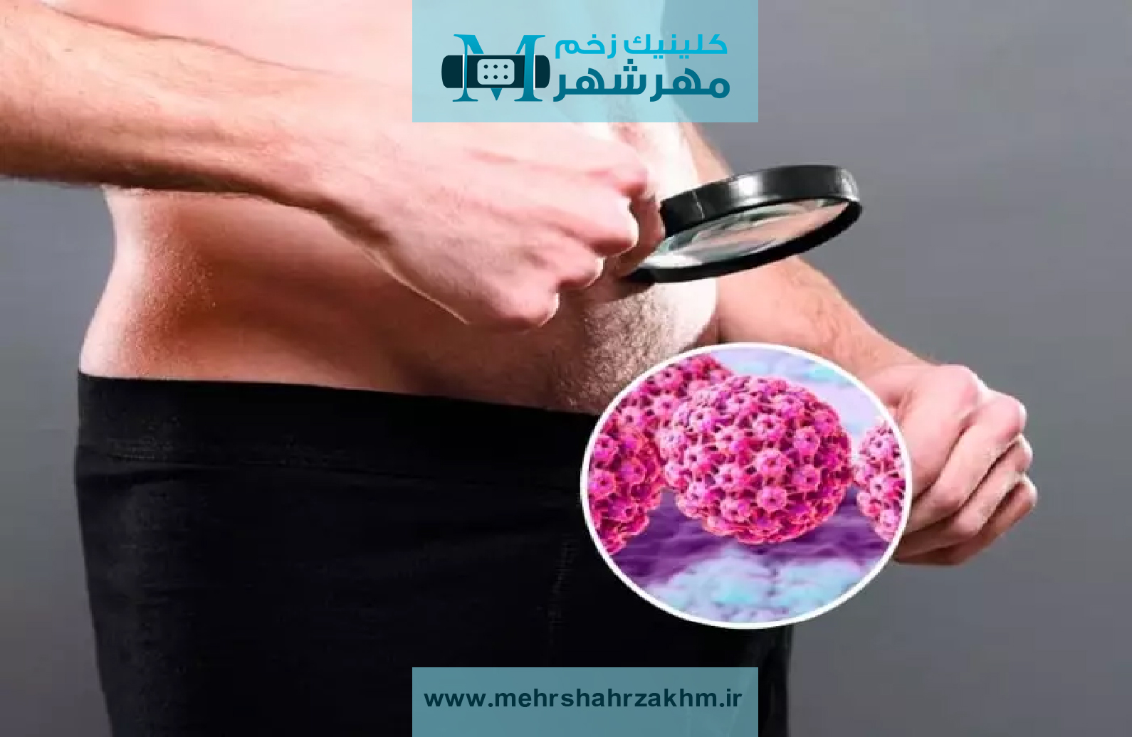 کرایوتراپی چیست و چگونه در درمان زگیل تناسلی کاربرد دارد؟