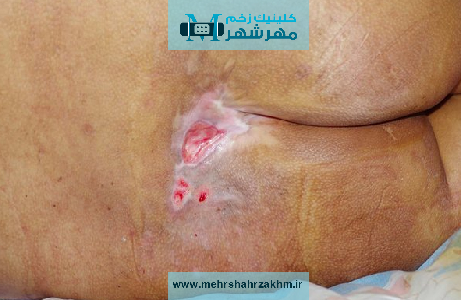 درمان قطعی زخم بستر در کرج با استفاده از تکنولوژی های پیشرفته