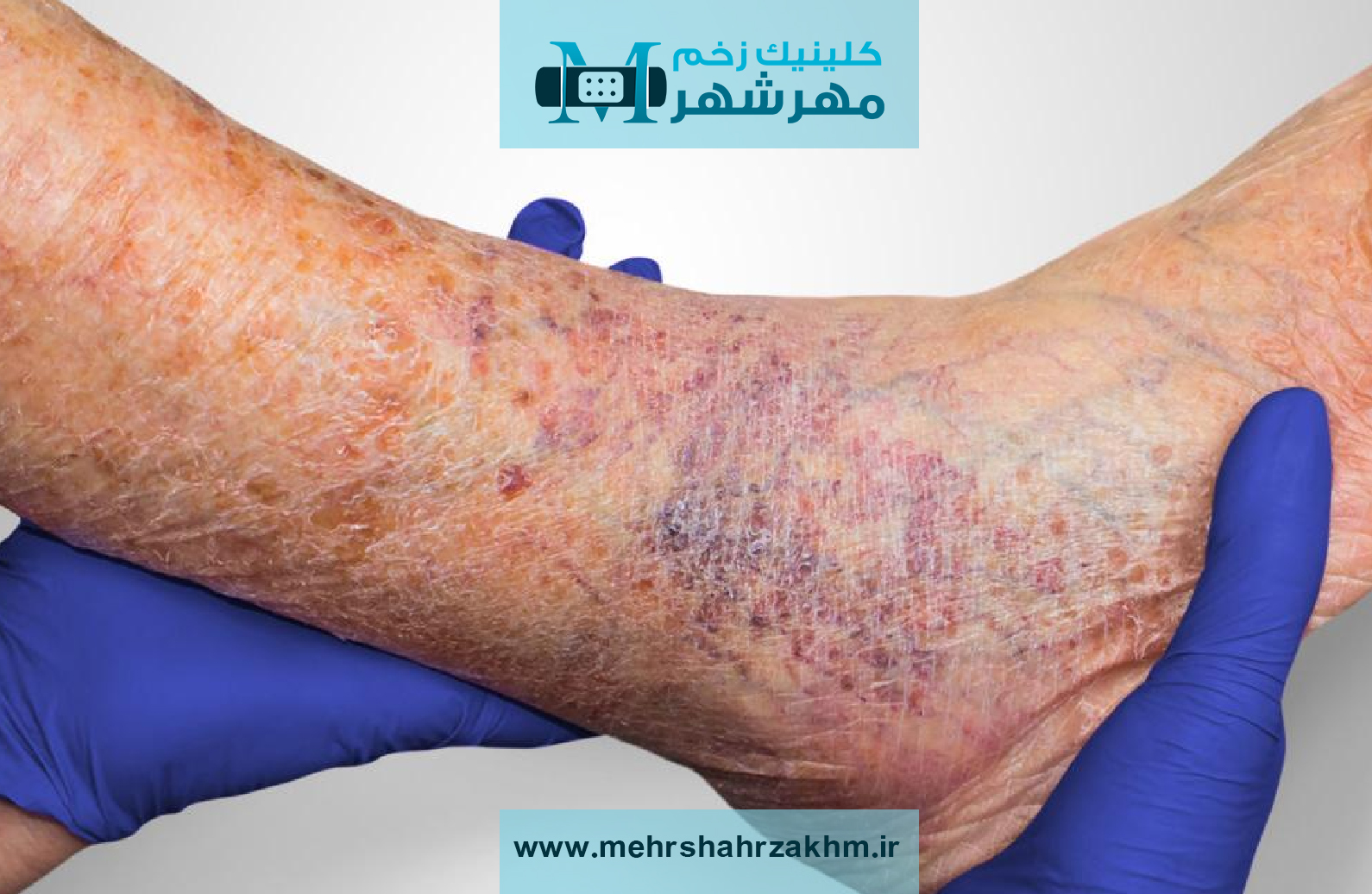 زخم های عروقی و جدیدترین تکنیک های درمان با روش های نوین پزشکی