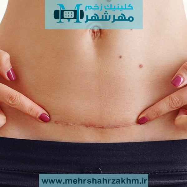 راهنمای جامع درمان عفونت بخیه سزارین