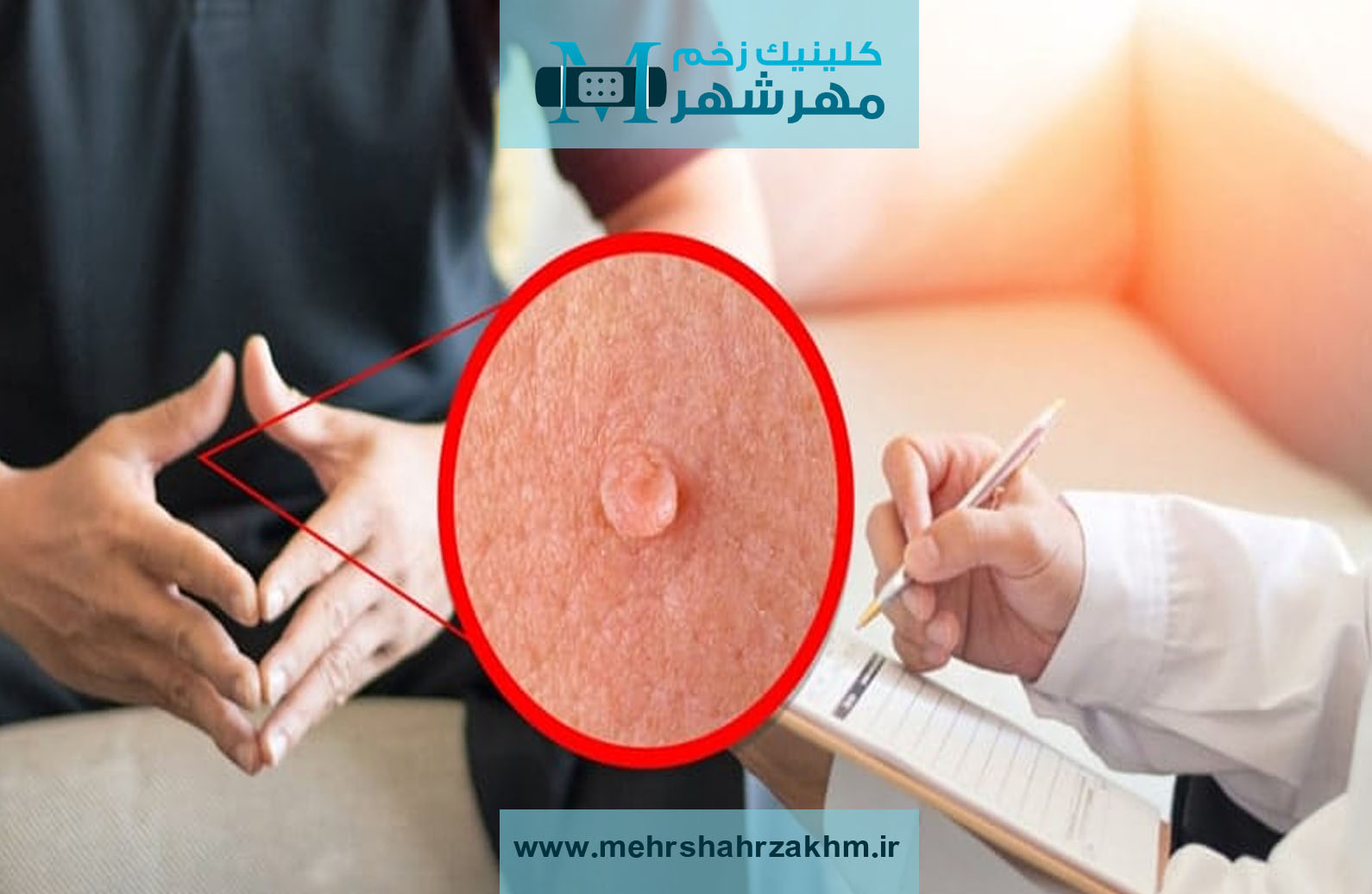 خدمات درمان زگیل تناسلی در کلینیک زخم از تشخیص تا درمان قطعی