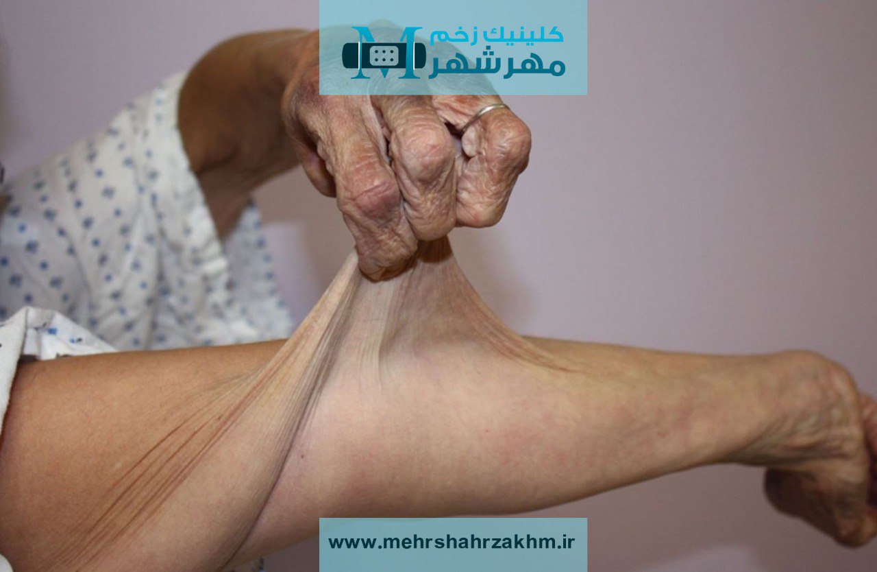 چگونه سندرم اهلرز دانلوس بر ساختار پوست و مفصل تأثیر می‌گذارد