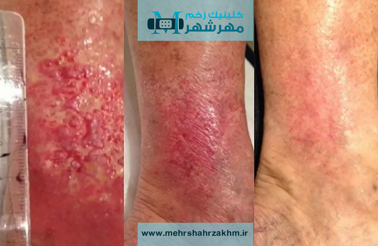 درمان قطعی زخم واریسی با روش‌های نوین پزشکی