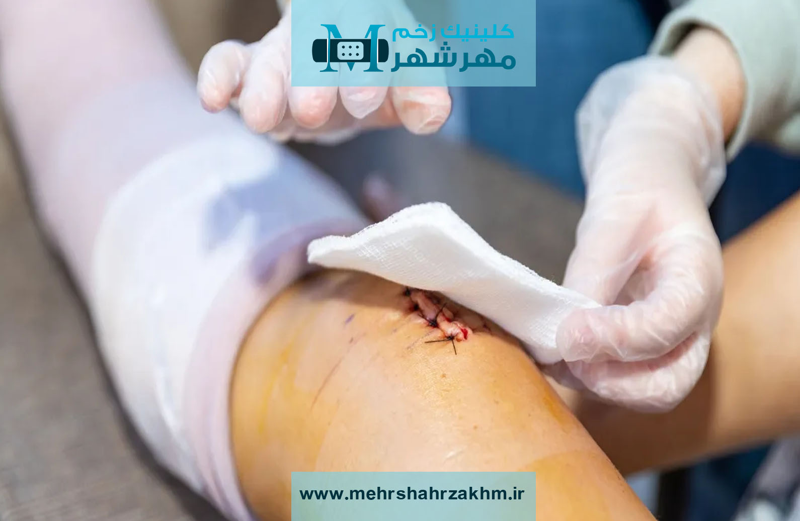 ارائه خدمات تخصصی مراقبت از زخم با جدیدترین متدها