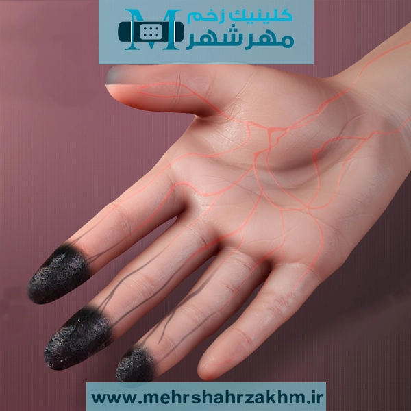 بیماری برگر چگونه باعث قطع عضو می‌شود؟