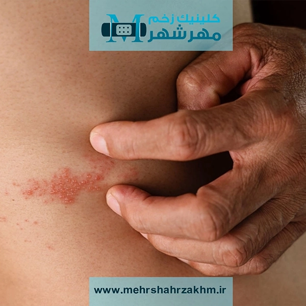 پمفیگوس چیست؟ علائم، علل و درمان بیماری خودایمنی پوستی