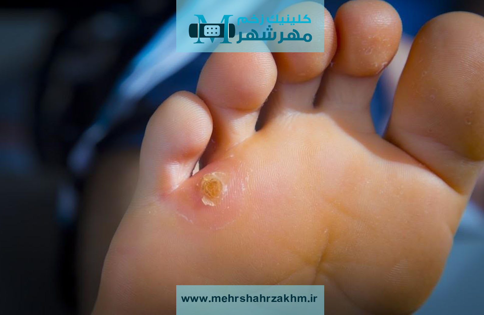 درمان قطعی میخچه با تجهیزات پیشرفته در کرج